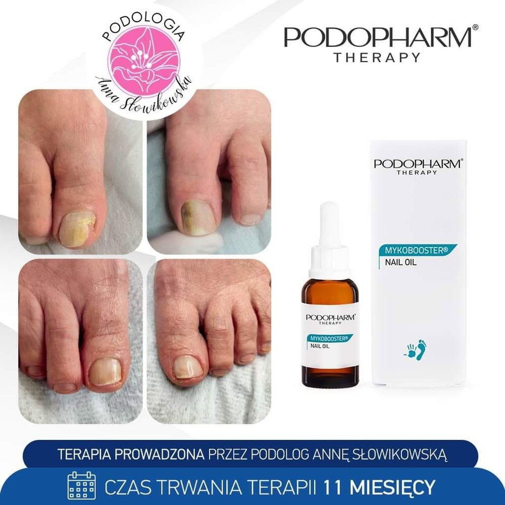 Evoluzione di un'onicomicosi durante un percorso PODOPHARM® con MYKOBOOSTER® Nail Oil